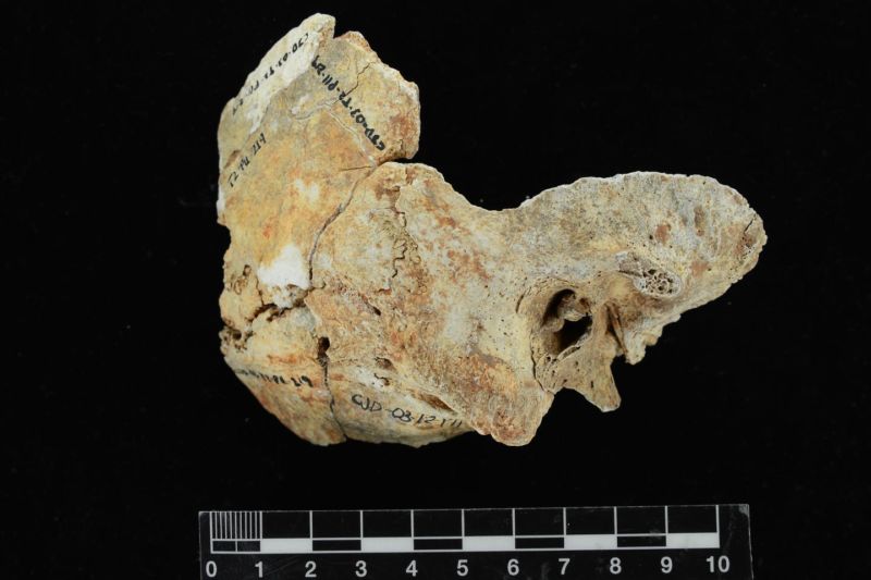 This temporal bone from a male skull unearthed at the site of a pre-Columbian village near the Gulf of Panama has bony bumps characteristic of surfer's ear.