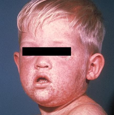 Face of boy after three days with measles rash.